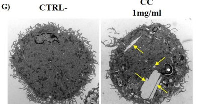 Cholesterol-mediated inflammation activation in alveolar macrophages