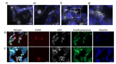 Altered cholesterol immunometabolism activates the macrophage NLRP3-inflammasome in lung fibrosis